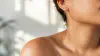 Acne Scarring: Types and What Actually Fades Them