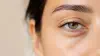 Dark Circles: What Actually Causes Them and What Helps