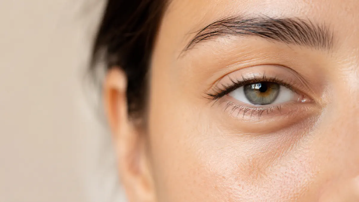 Under-eye area showing different types of dark circles